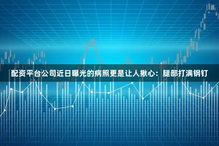 配资平台公司近日曝光的病照更是让人揪心：腿部打满钢钉